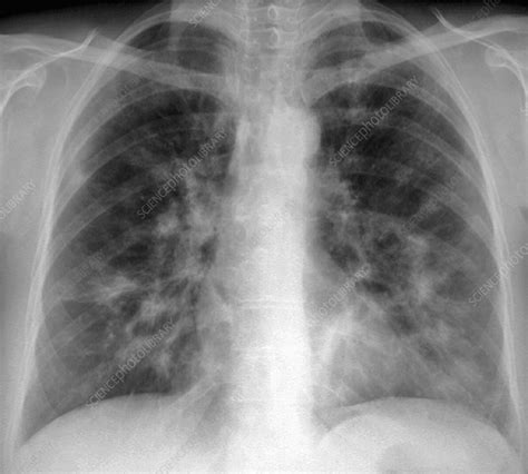 Interstitial Lung Disease X Ray