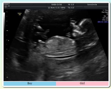 3D Ultrasound Ocala | 3D/4D & HDlive | Gender Reveal