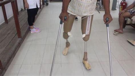 Full length transfemoral prostheses for bilateral amputee | Amputee, Full length