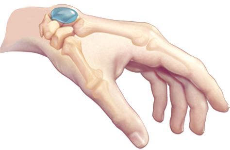 ganglion cyst on dorsal side of wrist | Ganglion Cysts | Information, Treatments & Remedies