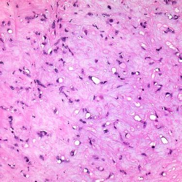 Epithelioid Hemangioendothelioma | Basicmedical Key