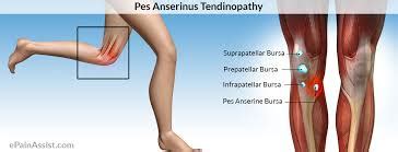 Pes anserinus tendinitis - uskum