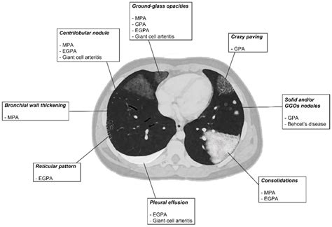 Diagnostics | Free Full-Text | Pulmonary Vasculitides: A Radiological Review Emphasizing ...