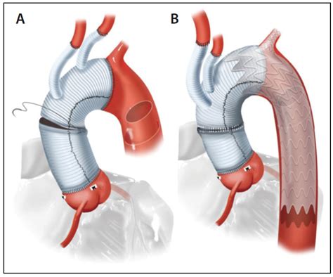 Figure 1 From Retrograde Ascending Aortic Dissection - vrogue.co