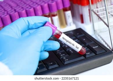 Hemoglobin Hb Test Look Abnormalities Blood Stock Photo 2235167121 | Shutterstock