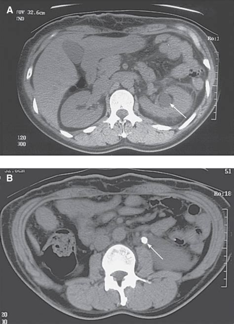 Glomerular Diseases | Abdominal Key