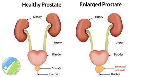 Prostate Enlargement - Symptoms, Causes & Treatment