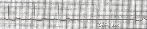 ECG Basics: Sinus Pause / Sinus Arrest | ECG Guru - Instructor Resources