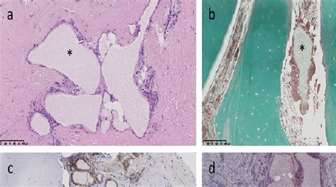 Histology of bone biopsies from the callus formed after 8 months, (a ...