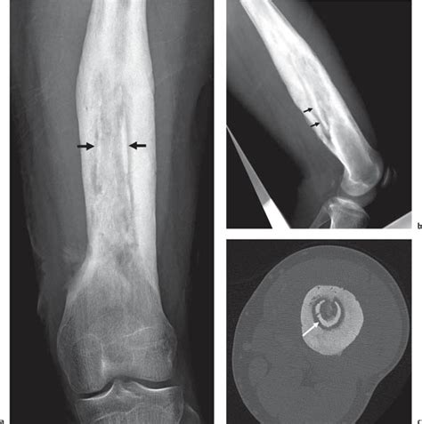 Periosteal Reaction | Radiology Key