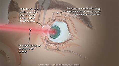 Best LASIK Eye Surgery Technology - drholzman