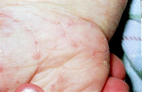 Permethrin treatment in scabies infestation: importance of the correct formulation | The BMJ