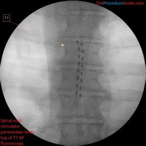 Abbott spinal cord stimulator problems - frosdmondo