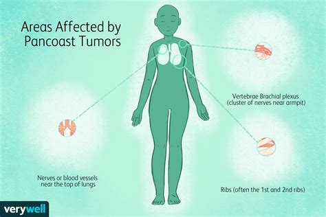 Pancoast Tumor Pain Worse At Night / Referred Pain Around The Shoulder ...