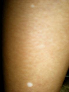 Unexplained White Spots on Your Skin? This Could Be Why | Age spot ...