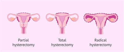 Types of Hysterectomy