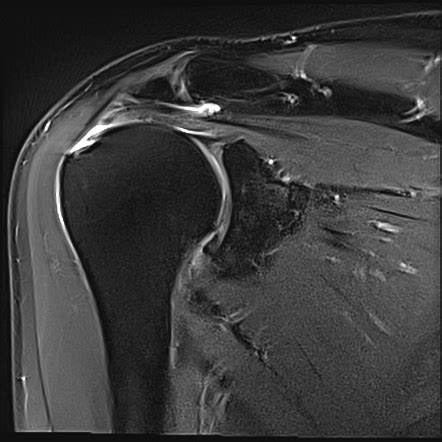 Supraspinatus Tendon Tear Radiology Reference Article Radiopaedia Org | The Best Porn Website