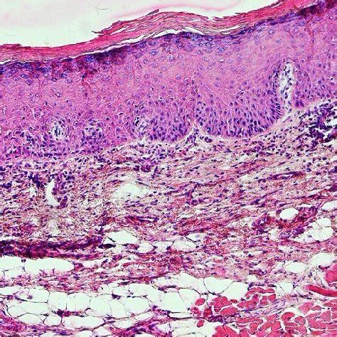 A photomicrograph showing atrophic oral epithelium with atypia,... | Download Scientific Diagram