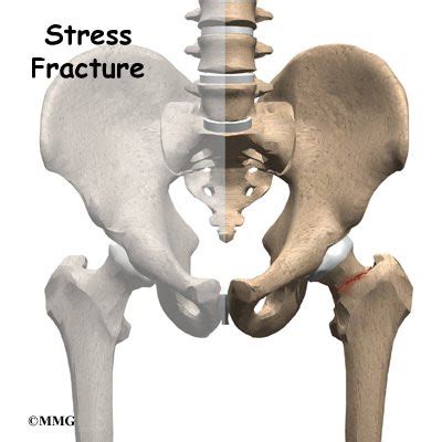 Stress Fracture of the Hip - Orthopedic Surgery, Algonquin, IL, Barrington, IL, Elgin, IL ...