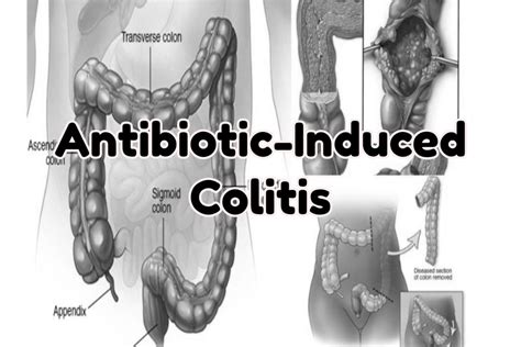 Gastroenterologists In Florida | Antibiotic-Induced Colitis: Secondary Complication of ...