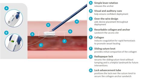 DeviceMD - MANTA® Vascular Closure Device