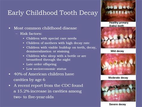 stages of tooth decay in children