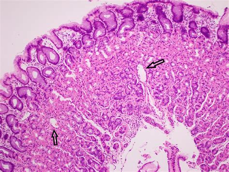 Portal Hypertension Histology