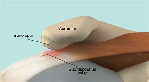 bone-spurs-on-the-undersurface-of-the-acromion-may-create-impingement-and-lead-to-cuff-wear-and ...