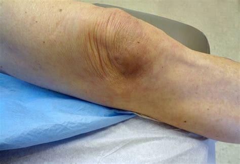 Post-traumatic Subcutaneous Hematoma