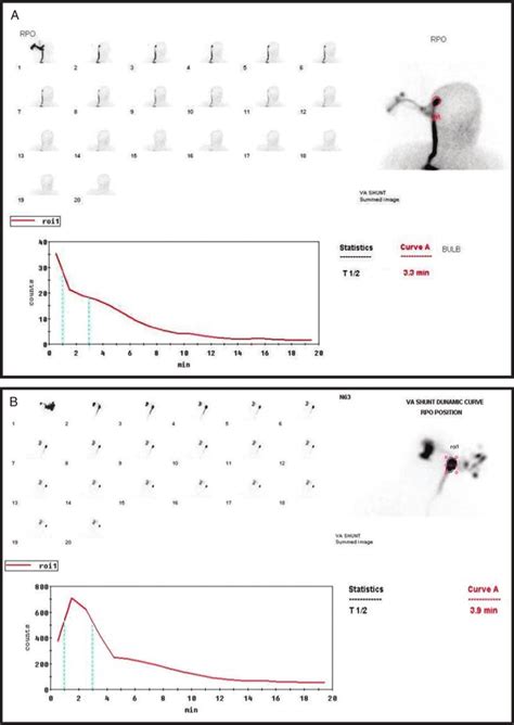 Shuntogram in a patient with hydrocephalus treated with a VA shunt. A... | Download Scientific ...