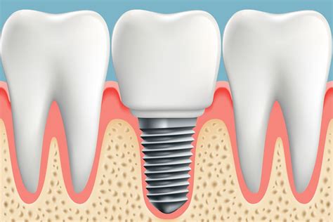 Implant-Supported Crown – Charlotte, NC – Ballantyne, NC