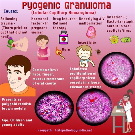 Pyogenic Granuloma | Oral pathology, Pathology, Medical mnemonics