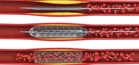 Angiography Vs Angiogram Vs Angioplasty. Know all about it. - PlanMyMedical