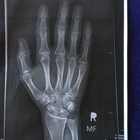 Oblique fracture on Metacarpal 3 and 4 : r/XRayPorn