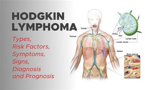 Hodgkin Lymphoma: Types, Risk Factors, Symptoms, Signs, Diagnosis and ...