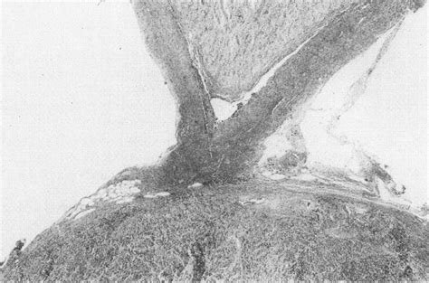 Low magnification showing the optic nerve, its dura, and the tumor. The ...