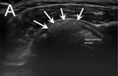 Calcific Tendinitis | Anesthesia Key