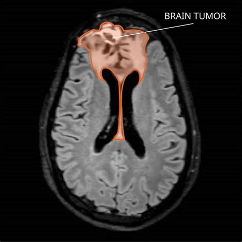 Oligodendroglioma and Other IDH-Mutated Tumors: Diagnosis and Treatment - NCI