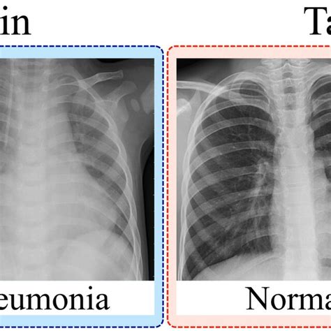 Pneumonia Chest X Ray Diagnosis