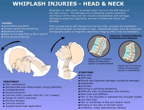 Whiplash Injury