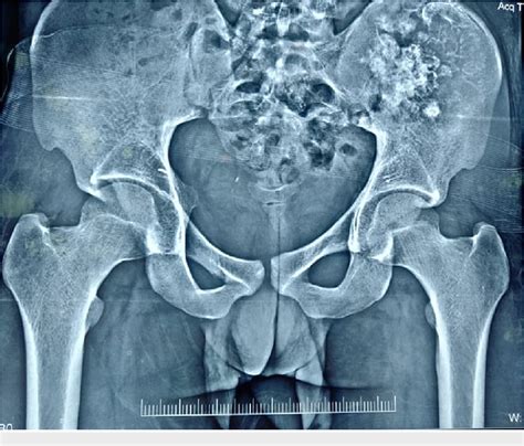 Figure 1 from Internal Hemipelvectomy and Pelvic Reconstruction With ...