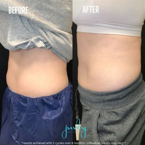 Juvly Aesthetics Gallery - CoolSculpting Fat Reduction | Juvl ...