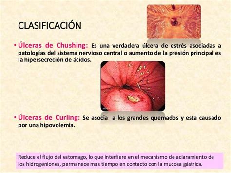 Curling Ulcer - Duodenal ulcer - symptoms, causes, diagnosis, Duodenal ... / A curling's ulcer ...