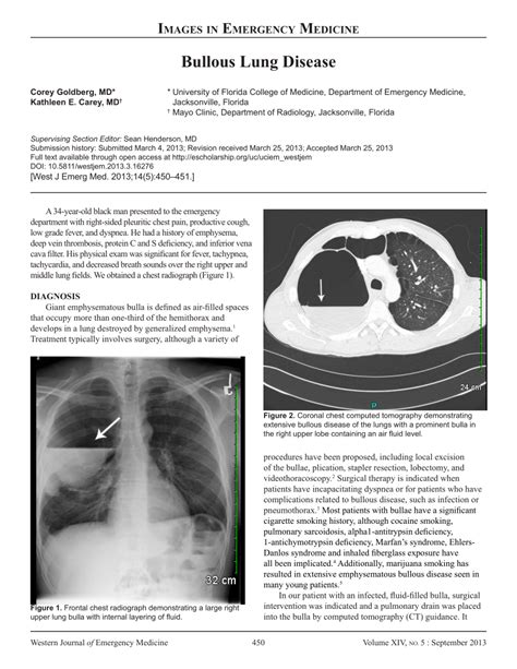 (PDF) Bullous Lung Disease