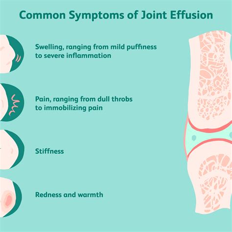 Joint Effusion Treatment