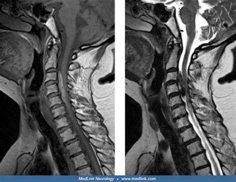 Superficial siderosis | MedLink Neurology