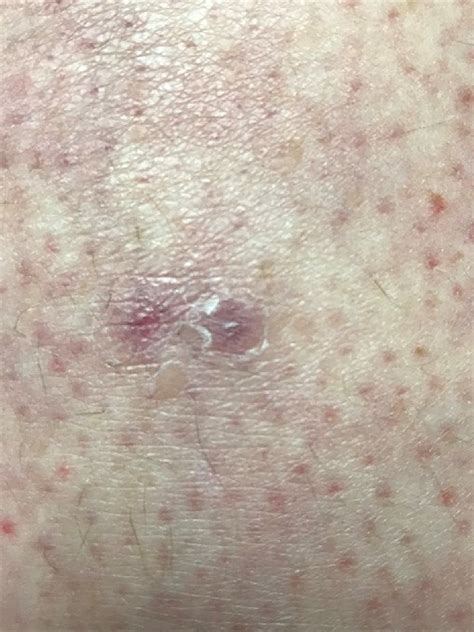 Treatment of Morgellons disease with doxycycline - Zhang - 2021 ...