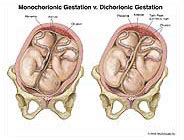 Twins Pregnancy and Delivery Medical and Trial Exhibits