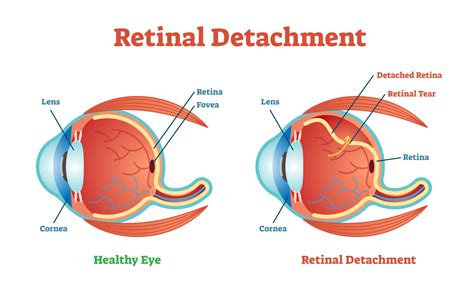 Lattice Degeneration: Causes, Symptoms, and Treatment