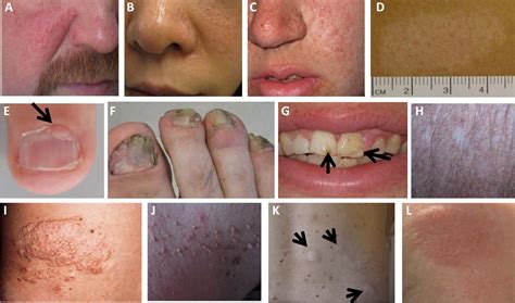 Tuberous Sclerosis Complex–Associated Angiomyolipomas: Focus on mTOR Inhibition - American ...